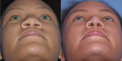 25-34 year old woman treated with African American Rhinoplasty - Great improvement of the nasal base after rhinoplasty