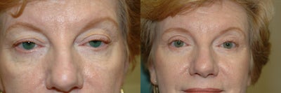 Cheek augmentation with cheek lift, ptosis repair, and elimination of festoons - 
	Patient treated for large unsightly festoons, mid face descent, loss of cheek prominence, upper eyelid ptosis, age related changes to the upper and lower eyelids
