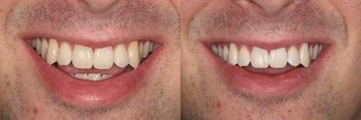 ZOOM whitening - 
	ZOOM whitening

