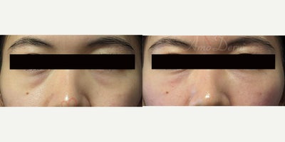 25-34 year old woman treated with Juvederm, Volbella, Voluma, Restylane - 4D Under Eye Lift - Treatment of dark circles & bags under eyes and cheek restoration with Belotero, Restylane, Volbella and Voluma