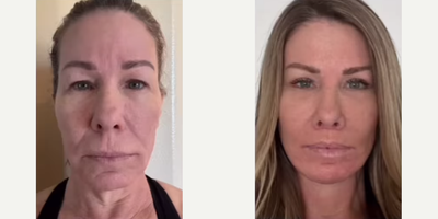 Woman treated with Facial Fat Transfer - Woman treated with Deep Plane Facelift, Neck Lift with reduction of glands and muscle, Lip Lift, Brow Lift, Eyelid Surgery, and Facial Fat Transfer.