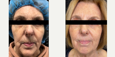55-64 year old woman treated with Vampire Facelift - This patient had a Vampire Facelift, using BellaFill and PRP to help restore volume and rejuvenate the skin.