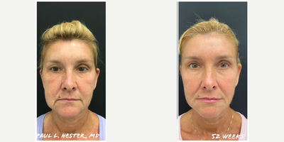 55-64 year old woman treated with FaceTite - Dr. Hester has tightened, lifted, and contoured the lower face by hand leaving an absolutely gorgeous profile! These results are after 1 year!! 