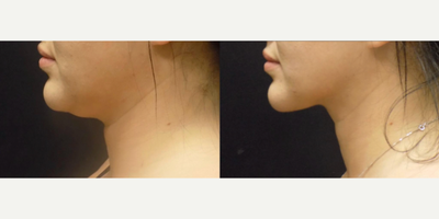 Woman treated with Neck Liposuction - Yesterdays story was a sneak peek of my assistant who wanted neck lipo and a BBL for her birthday. Shes one month out and ....well, see what she has to say. She told me her tips doubled when she went back to her bartending job because of her butt. I told her it was just her renews confidence shining through. Either way, shes thrilled.