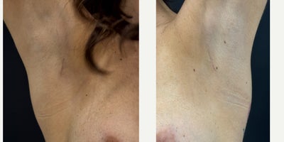 40year old woman treated with MIA Femtech Trans Axillary Breast Harmonisation - This patient underwent a Bilateral Breast Harmonisation with MIA Femtech, with the placement of Diamond Shaped Mia implants 165 cc, submammary through a 2 cm incision in the axilla, under local anaesthetic and conscious sedation. Patient before and 4 weeks after surgery. She had an amazing recovery, back in work within 5 days and a natural cosmetic result, achieved with breast preservation nesting technique.