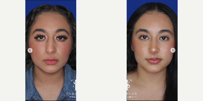 Woman treated with Rhinoplasty - Woman treated with Rhinoplasty