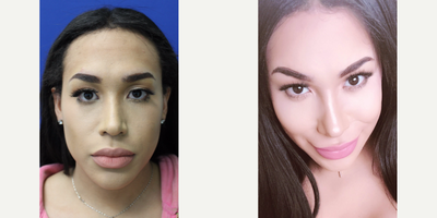 25-34 year old woman treated with Facial Feminization Surgery - 25-34 year old woman treated with Facial Feminization Surgery