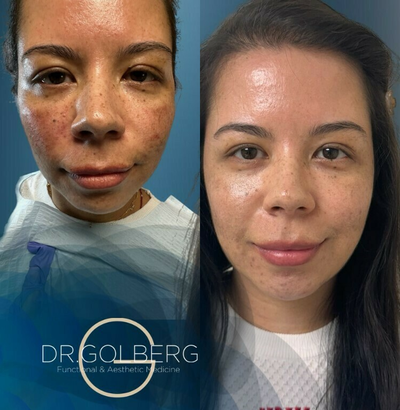 Woman treated with PRF Treatment, Radiesse - Rediscover your skins natural glow with our transformative treatments combining Radiesse and Platelet-Rich Fibrin (PRF). This powerful duo restores volume and promotes skin regeneration, bringing back the radiance and vitality of youthful skin.