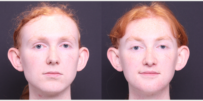 18-24 year old transgender woman treated with Facial Feminization Surgery, Jaw Reduction - thyroplasty, brow lift, brow bone reduction, hairline advancement, lip lift, mandible/chin contouring, sliding genioplasty, submental liposuction