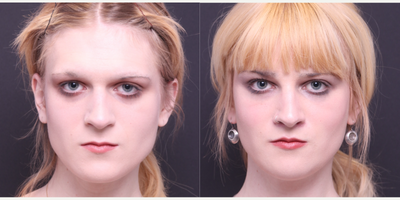 25-34 year old transgender woman treated with Facial Feminization Surgery, Jaw Reduction, Lip Lift - Fat grafting to the face, brow bone reduction, frontal brow lift, hairline advancement, upper lip lift with augmentation, mandible/chin contouring