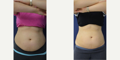 Woman treated with CoolSculpting - Woman treated with CoolSculpting