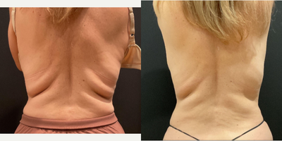25-34 year old man treated with Eon - Eon Fat Reduction in Austin and San Antonio