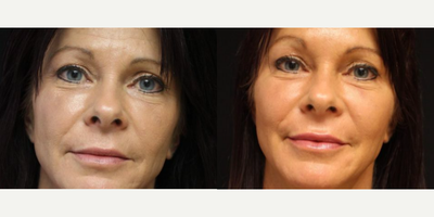 Woman treated with Bellafill - Bellafill