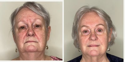 65-74 year old woman treated with Dermal Fillers, Microneedling RF, Agnes RF - Full Face Rejuvenation With Dermal Fillers and RF MicroneedlingFull face rejuvenation can be effectively achieved using a customized combination approach. Dermal fillers are used to improve nasolabial folds, soften marionette lines, enhance lip volume, and refine chin projection for better facial balance and contour. To further enhance results, RF microneedling helps tighten the skin, improve texture, and reduce redness associated with rosacea by stimulating collagen remodeling. This multi-modal treatment approach delivers natural-looking, long-lasting facial rejuvenation with improved skin tone, firmness, and overall harmony.