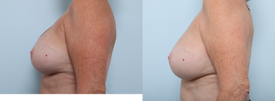 Strattice - Bilateral Breast Implant Exchange with Strattice