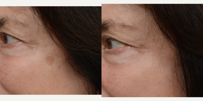 65-74 year old woman treated with PicoWay - 1 treatment of picoway