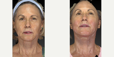 65-74 year old woman treated with Neck Lift - This very pretty woman was concerned about her jowl area and the excess skin under her neck. We did a lower face and neck lift with platysmaplasty.  Looking good!