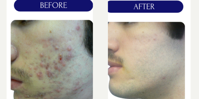 17 or under year old man treated with LaserACNE TREATMENT - LASER ACNE TREATMENT