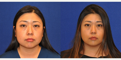 Buccal Fat Removal - Buccal Fat Removal