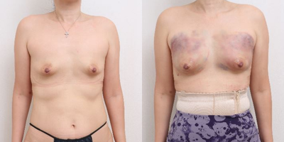 45-54 year old woman treated with Nonsurgical Breast Lift - 43 Years old female patient Chief Complain: absolutely volume-less breast ( after few pregnancies and long breast feeding) Treatment Plan: mammary glands get shrink, only skin left. Fat pad is very thin as well. As patient was against breast implants, breast fat transfer was selected. Outcome: 200cc pure fat with stem cells was injected for 1st round. Breast become more fulled.