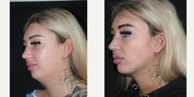 25-34 year old woman treated with Chin Liposuction - My patient cameto have chin liposuction. Chin liposuction is used for to get rid of stubborn fat under the chin and enhances jaw line contour. She still has swellings and minimal bruising but will be much better in a few weeks.