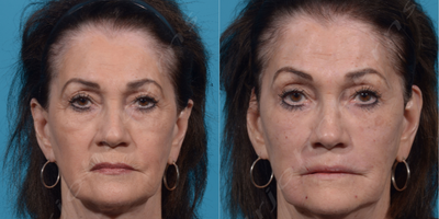 65-74 year old woman treated with Microneedling - Liquid facelift:Botox: glabella, forehead, crows feetMidface: VolumaNasolabial folds/Marionette lines: VollureLip Lines: VolbellaSkin Resurfacing: Microneedling with PRP and AquaGold microbotox