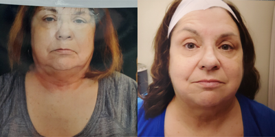 65-74 year old woman treated with Morpheus8 - A woman in her 60s treated with a single submental coolsculpting treatment followed by monthly Morpheus 8 times two