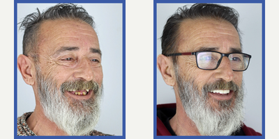 55-64 year old man treated with All-on-4 Dental Implants - Our patient had serious perodontal disease which led to tooth and bone loss. The condition of existing teeth were not healthy. Therefore all-on-4 treatment has been applied and he had been able to eat and smile healthy.