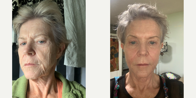 55-64 year old woman treated with SmartSkin, Jeuveau, Sculptra - This 63 yr old client had not done any aesthetic procedures for many years. She had Jeuveau botulinum toxin to the upper face, followed a week later by a single session of SmartSkin CO2 Laser Skin Resurfacing and TriWave LED light treatments to help speed her healing. She then had 3 vials of Sculptra- 1 per side of the face, and 1 for the anterior neck. We will expect her skin to continue to improve further for at least 2 more months and will plan a second session of Sculptra down the road.