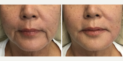 65-74 year old woman treated with Restylane Kysse, Sculptra Aesthetic, Contour Thread Lift - 68 yr old female - concerned about oral commissures (marionette lines) making her look sad around the mouth.   Sculptra, Restylane Refyne and 4 Infiniti PDO threads placed with no bruising.  Immediate untouched photos - pt had an excellent result with minimal discomfort.   She had tears of joy as this had been a problem for many years.