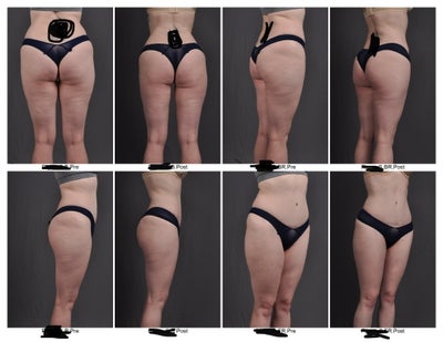 low c of g lipo 34 Yr/old (Almost Full Body) and J-Plasma Review Lipoabdominoplasty - Clinics in Plastic