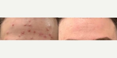 Patient treated with Skin Rejuvenation - Our bespoke acne solutions combine AviClear & other laser treatments, soothing infrared light therapy, & an exclusive range of at-home skincare products.Say goodbye to stubborn acne & hello to your clearest, most radiant skin!
