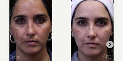 Woman treated with Clear and Brilliant - Its all about the reflection of light on the skin. This young lady complained of dull looking skin and dark circles. She has had a series of 6 clear and brilliant laser, under the eye fillers and Botox treatments.