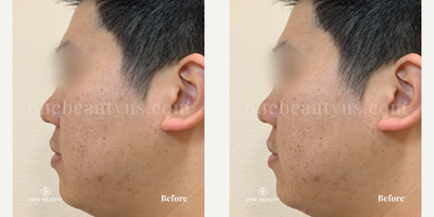 25-34 year old man treated with Stellar M22 - A young man in his mid-20s exhibits freckles and acne scarring on his face. After undergoing four treatment sessions, there are significant improvements observed, with a marked enhancement in the clarity of his skin.