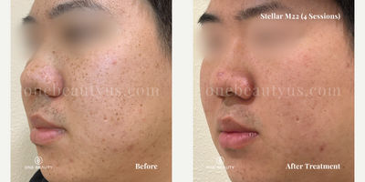25-34 year old man treated with Stellar M22 - A young man in his mid-20s exhibits freckles and acne scarring on his face. After undergoing four treatment sessions, there are significant improvements observed, with a marked enhancement in the clarity of his skin.