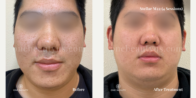 25-34 year old man treated with Stellar M22 - A young man in his mid-20s exhibits freckles and acne scarring on his face. After undergoing four treatment sessions, there are significant improvements observed, with a marked enhancement in the clarity of his skin.