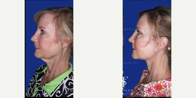 55-64 year old woman treated with Neck Lift - 55-64 year old woman treated with Neck Lift