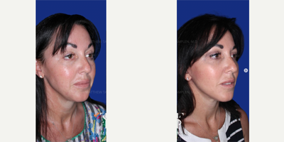 45-54 year old woman treated with Neck Lift - 45-54 year old woman treated with Neck Lift