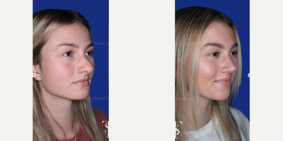 25-34 year old woman treated with Revision Rhinoplasty - 25-34 year old woman treated with Revision Rhinoplasty