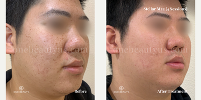 25-34 year old man treated with Stellar M22 - A young man in his mid-20s exhibits freckles and acne scarring on his face. After undergoing four treatment sessions, there are significant improvements observed, with a marked enhancement in the clarity of his skin.