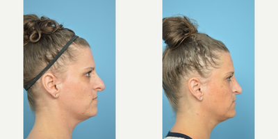 35-44 year old woman treated with Revision Rhinoplasty - This patient underwent a Revision Rhinoplasty to bring the size of the nose in harmony with the rest of her face.
