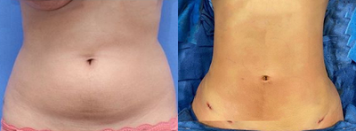 Woman treated with Liposuction - Woman treated with Liposuction