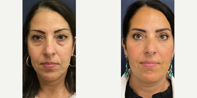 Woman treated with Eyelid Surgery, TCA Peel - Before and After upper and lower eyelid blepharoplasty and 30%n TCA peel on this beautiful 55- year old patient. I was using filler under her eyes with good results until last year when it stopped working.