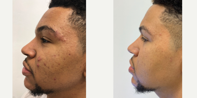 Combo LED Light Therapy with HydraFacials & eTwo - Combination acne treatment utilizing LED Light Therapy with HydraFacials then eTwo treatments to address scarring.