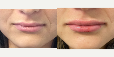 18-24 year old woman treated with Volbella - Volbella lip filler immediately after injection. By Steve