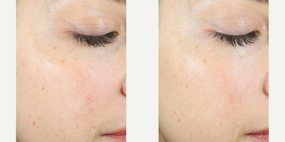 Skinbetter Science - AlphaRet Exfoliating Peel Pads.Photo provided courtesy of Skinbetter Science.