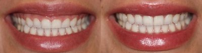 25-34 year old woman treated with Gum Lift - Correction of a gummy smile using a laser to remove excess gum tissue.