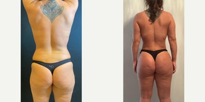 Woman treated with Brazilian Butt Lift - Woman treated with Brazilian Butt Lift