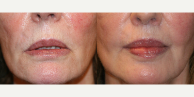 65-74 year old woman treated with upper lip lift, corner lip lift, lower  V2Y plasty and CO2 laser - This female patient had classic signs of perioral aging, including a long upper lip, asymmetrically ptotic corners as well as a sagging lower lip. She had no upper tooth show and all lower. She underwent an upper lip lift, corner lip lifts and a lower lip V2Y plasty as well as laser skin resurfacing of her lip region.