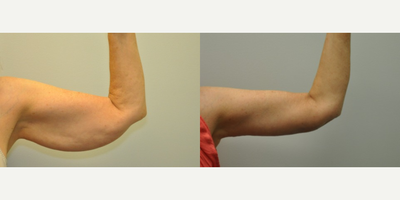 66 year old woman treated with Arm Lift - 66 year old woman 1 year following treatment with brachioplasty